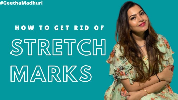 How to Get Rid of Stretch Marks,Geetha Madhuri: Home Remedies for Stretch Marks,#GeethaMadhuri,Do stretch marks ever really go away?,How long do stretch marks take to fade?,How can I get rid of stretch marks naturally?,How are stretch marks caused?