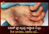 Centre Releases Advisory to States on Tomato Flu Disease, Centeral Governmemt Advise To States on Tomato Flu Disease, Tomato Flu Disease Latest News, Tomato Flu Disease Live Updates, Centre Issues Advisory To States On Tomato Flu, Tomato Fever, Tomato Flu, Tomato Flu Outbreak In India, Tomato Flu Symptoms And Causes, Tomato Flu Treatment, Centre Issues Guidelines on Tomato Flu, Central Government Guidelines For Tomato Flu, Mango News, Mango News Telugu,