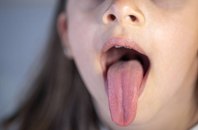 throw the tongue the disease will reveal Throw The Tongue The Disease Will Reveal,Tongue Will Reveal Disease, Cracks On The Tongue, Plaque Build-Up On The Tongue, Tongue Discoloration, Tongue Problems,Tongue Cancer,Tongue Health Signs,Tongue Disease,Mango News,Mango News Telugu