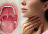 Swelling Of Tonsils Can Be Reduced Like This, Tonsils Can Be Reduced Like This, Tonsils Swelling, Swollen Tonsil Causes, And Treatment, Remedies For Tonsil Infections, Tonsils Problem, Tonsillitis Care Instructions, Tonsil And Adenoid Problems, Causes Of Swollen Tonsils, Mango News, Mango News Telugu,