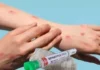 The First Vaccine For Empox, Vaccine For Empox, Empox Vaccine, Empox Vaccine Update, Vaccine, Latest Empox Vaccine News, Bavarian Nordic Company Manufacturing, Monkey Pox, WHO, Mpox, What to know About Mpox Causes, Monkeypox Prevention, Monkeypox Symptoms, New Virus, Health News, Health Tips, Healthy Food, Healthy Diet, Fitness, Mango News, Mango News Telugu