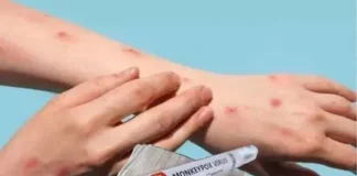 The First Vaccine For Empox, Vaccine For Empox, Empox Vaccine, Empox Vaccine Update, Vaccine, Latest Empox Vaccine News, Bavarian Nordic Company Manufacturing, Monkey Pox, WHO, Mpox, What to know About Mpox Causes, Monkeypox Prevention, Monkeypox Symptoms, New Virus, Health News, Health Tips, Healthy Food, Healthy Diet, Fitness, Mango News, Mango News Telugu