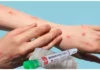 First Monkeypox Case Registered In India, First Monkeypox Case, Monkeypox Case In India, India Monkeypox Case, First Mpox Case In India, Isolate, Monkeypox, Global Public Health Emergency, W.H.O, Mpox, What to know About Mpox Causes, Monkeypox Prevention, Monkeypox Symptoms, New Virus, Health News, Health Tips, Healthy Food, Healthy Diet, Fitness, Mango News, Mango News Telugu