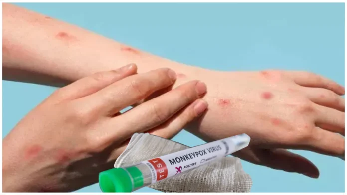 First Monkeypox Case Registered In India, First Monkeypox Case, Monkeypox Case In India, India Monkeypox Case, First Mpox Case In India, Isolate, Monkeypox, Global Public Health Emergency, W.H.O, Mpox, What to know About Mpox Causes, Monkeypox Prevention, Monkeypox Symptoms, New Virus, Health News, Health Tips, Healthy Food, Healthy Diet, Fitness, Mango News, Mango News Telugu
