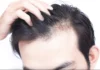 Do This To Prevent Hair Fall, Get Rid Of Hair Problems, Hair Problems, Black, Hair Fall, Hair Tips, Thick Hair, Common Hair Problems, Hair Loss Tips, Home Remedies for Dry Hair, Tips For Black Hair, Black Hair Tips, Health News, Health Tips, Healthy Food, Healthy Diet, Fitness, Mango News, Mango News Telugu