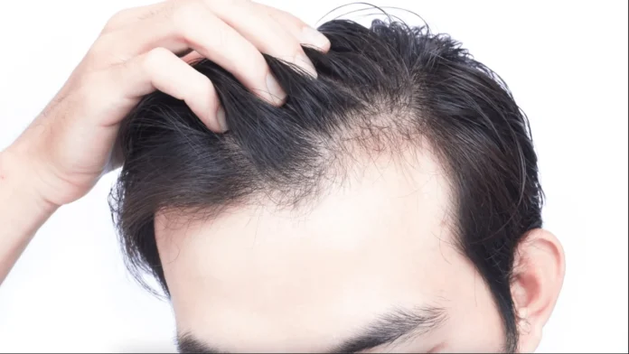 Do This To Prevent Hair Fall, Get Rid Of Hair Problems, Hair Problems, Black, Hair Fall, Hair Tips, Thick Hair, Common Hair Problems, Hair Loss Tips, Home Remedies for Dry Hair, Tips For Black Hair, Black Hair Tips, Health News, Health Tips, Healthy Food, Healthy Diet, Fitness, Mango News, Mango News Telugu