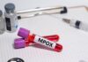First Mpox Case Reported In Bengaluru Government On High Alert