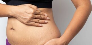 Try This To Get Rid Of Stretch Marks, Get Rid Of Stretch Marks, Stretch Marks Removal, Stretch Marks Causes, How Do I Get Rid of My Stretch Marks, Obesity, Pregnancy, Stretch Marks, Try This To Get Rid Of Stretch Marks, Health, Health News, Health Tips, Healthy Food, Healthy Diet, Fitness, Mango News, Mango News Telugu