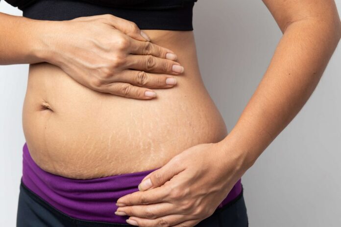 Try This To Get Rid Of Stretch Marks, Get Rid Of Stretch Marks, Stretch Marks Removal, Stretch Marks Causes, How Do I Get Rid of My Stretch Marks, Obesity, Pregnancy, Stretch Marks, Try This To Get Rid Of Stretch Marks, Health, Health News, Health Tips, Healthy Food, Healthy Diet, Fitness, Mango News, Mango News Telugu