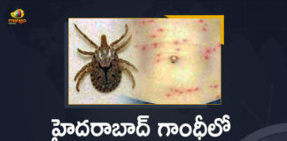 15 Scrub Typhus Cases Reported, 15 Scrub Typhus Cases Reported at Hyderabad, 15 Scrub Typhus Cases Reported at Hyderabad Gandhi Hospital, Gandhi Hospital, Hyderabad Gandhi Hospital, Mango News, Mango News Telugu, Scrub Typhus, Scrub Typhus Cases, Scrub Typhus Cases Reported at Hyderabad Gandhi Hospital, scrub typhus in telugu, scrub typhus symptoms, scrub typhus symptoms scrub typhus, scrub typhus test, scrub typhus treatment