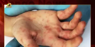 Centre Releases Advisory to States on Tomato Flu Disease, Centeral Governmemt Advise To States on Tomato Flu Disease, Tomato Flu Disease Latest News, Tomato Flu Disease Live Updates, Centre Issues Advisory To States On Tomato Flu, Tomato Fever, Tomato Flu, Tomato Flu Outbreak In India, Tomato Flu Symptoms And Causes, Tomato Flu Treatment, Centre Issues Guidelines on Tomato Flu, Central Government Guidelines For Tomato Flu, Mango News, Mango News Telugu,