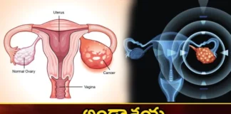 The Increasing Threat of Ovarian Cancer in Women Know The Symptoms,The Increasing Threat of Ovarian Cancer,Ovarian Cancer in Women,Know The Symptoms of Ovarian Cancer,Mango News,Mango News Telugu,Various cancers,ovarian cancer, The increasing threat of ovarian cancer in women, ovarian cancer symptoms, Cancer diagnosis,Awareness of ovarian cancer,Ovarian Cancer Risk Factors,Threat of Ovarian Cancer Latest News,Threat of Ovarian Cancer Latest Updates,Ovarian Cancer Latest News,Ovarian Cancer Latest Updates