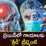 3D treatment for brain injuries,3D treatment for brain,brain injuries,treatment for brain,Mango News,Mango News Telugu,3D treatment,3D treatment for brain,brain injuries,brain, brain treatment, Cerebral cortex, Outer layer of the brain, TBI, tissue,3D treatment for brain Latest News,3D treatment for brain Latest Updates,3D treatment for brain Live News,brain treatment Latest Update