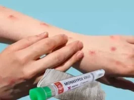 The First Vaccine For Empox, Vaccine For Empox, Empox Vaccine, Empox Vaccine Update, Vaccine, Latest Empox Vaccine News, Bavarian Nordic Company Manufacturing, Monkey Pox, WHO, Mpox, What to know About Mpox Causes, Monkeypox Prevention, Monkeypox Symptoms, New Virus, Health News, Health Tips, Healthy Food, Healthy Diet, Fitness, Mango News, Mango News Telugu