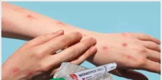 First Monkeypox Case Registered In India, First Monkeypox Case, Monkeypox Case In India, India Monkeypox Case, First Mpox Case In India, Isolate, Monkeypox, Global Public Health Emergency, W.H.O, Mpox, What to know About Mpox Causes, Monkeypox Prevention, Monkeypox Symptoms, New Virus, Health News, Health Tips, Healthy Food, Healthy Diet, Fitness, Mango News, Mango News Telugu