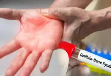Guillain Barre Syndrome First Case In The State How Dangerous Is It, Guillain Barre Syndrome First Case, First Case In The State, Guillain Barre Syndrome Symptoms, Guillain-Barré syndrome Treatment, Guillain Barré Syndrome, Immune System, Neurological Disorder, Treatment Cost, Hyderabad, Hyderabad Live Updates, Latest Hyderabad News, Telangana, TS Politics, TS Live Updates, Political News, Mango News, Mango News Telugu