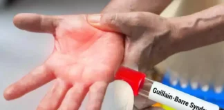 Guillain Barre Syndrome First Case In The State How Dangerous Is It, Guillain Barre Syndrome First Case, First Case In The State, Guillain Barre Syndrome Symptoms, Guillain-Barré syndrome Treatment, Guillain Barré Syndrome, Immune System, Neurological Disorder, Treatment Cost, Hyderabad, Hyderabad Live Updates, Latest Hyderabad News, Telangana, TS Politics, TS Live Updates, Political News, Mango News, Mango News Telugu