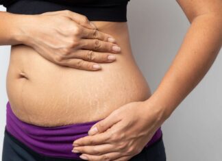 Try This To Get Rid Of Stretch Marks, Get Rid Of Stretch Marks, Stretch Marks Removal, Stretch Marks Causes, How Do I Get Rid of My Stretch Marks, Obesity, Pregnancy, Stretch Marks, Try This To Get Rid Of Stretch Marks, Health, Health News, Health Tips, Healthy Food, Healthy Diet, Fitness, Mango News, Mango News Telugu