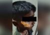Fevikwik Treatment A Shocking Incident In Karnataka Government Hospital, Fevikwik Treatment, A Shocking Incident In Karnataka, Karnataka Government Hospital, Fevikwik, Government Hospital, Medical Negligence, Nurse, Karnataka, Latest Karnataka News, Live Updates, Breaking News, Headlines, Live News, Mango News, Mango News Telugu
